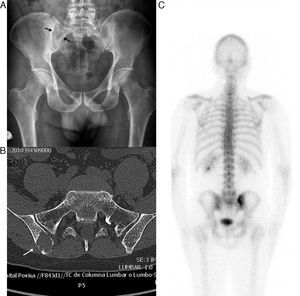 A) Proyección radiográfica frontal de la pelvis del paciente en la que se aprecia una lesión osteolítica con contornos lobulados y septos en su interior. B) Tomografía computarizada. Corte axial a la altura de las articulaciones sacroilíacas, en el que se visualiza un área lítica sin insuflación ósea ni esclerosis reactiva que destruye el hueso cortical. C) Fase ósea de la gammagrafía con difosfonato de metileno marcado con 99m Tc, en la que se objetiva hipercaptación sobre la porción posterior del ilíaco derecho adyacente a la articulación sacroilíaca.