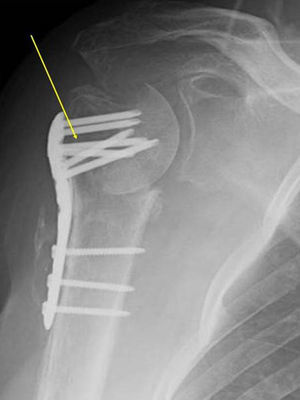 Osteosíntesis con placa y tornillos. Obsérvese la imposibilidad de corrección de la angulación inicial cervicodiafisaria, lo que empeoraría el arco móvil y predispondría a seudoartrosis.