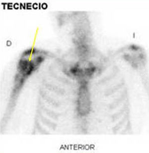 Hipercaptación gammagráfica en húmero proximal derecho.