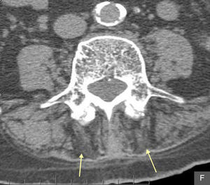 Imagen axial de TC realizada en L4. Atrofia selectiva de la musculatura paravertebral posterior y degeneración/sustitución grasa (flechas amarillas).