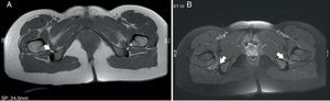 A) Axial T1: pinzamiento de los espacios isquiofemoral (flecha gruesa) y cuadrado femoral (asterisco). B) Axial T2 con supresión de la señal grasa: edema en ambos músculos cuadrado femorales.