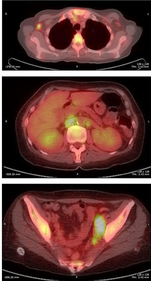 PET SCAN que evidencia poliadenopatías hipermetabólicas axilares, abdominales y pélvicas.