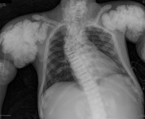 Calcificaciones periarticulares de aspecto nodular en hombros. Osteoesclerosis platillovertebrales superior e inferior (columna en jersey de rugby) y colapsos vertebrales dorsales 5 y 6. Crecimiento en forma de bulbo de los extremos de las costillas y clavículas. Osteoesclerosis de clavículas y secuelas de fracturas costales. Fractura del húmero derecho.