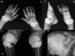 A) Radiografía de manos con calcinosis periarticular en interfalángicas, metacarpofalángicas y carpos, disminución de la densidad ósea, resorción de las epífisis distales del cúbito y radio. B) Radiografía de pies con calcinosis periarticular en interfalángicas, metatarsofalángicas y articulación tibioastragalina, osteoesclerosis en falanges y metatarsianos, luxación de las articulaciones tibioastragalinas, resorción ósea de la epífisis distal de la tibia y peroné. C) Radiografía de rodillas con calcinosis tumoral periarticular, fractura supracondílea bilateral, con desviación medial de la diáfisis femoral. D) Radiografía de hombro con calcinosis tumoral periarticular, resorción de la cabeza y cuello humerales, resorción ósea de la clavícula.