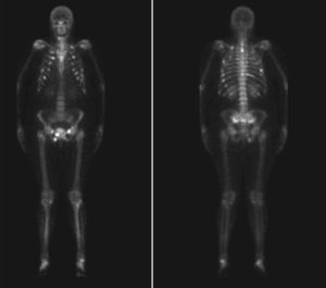 Rastreo óseo: afectación ósea múltiple, con fijación del trazador (difosfonatos-Tc 99m) en arcos costales bilaterales, algún cuerpo vertebral, la rama horizontal del pubis y rama isquiopubiana derecha.