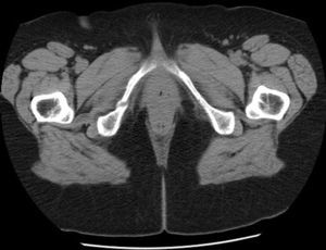 TC de pelvis: fracturas múltiples en diferentes estadios de evolución a nivel de pubis derecho e isquion bilateralmente.