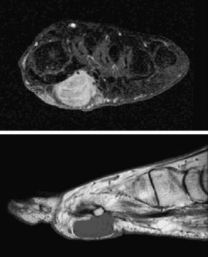 RM de pie izquierdo: tumor sólido de partes blandas, polilobulado, que mide 5,3×2,6×2 cm, de localización subdérmica, que se introduce en profundidad en el plano muscular, separado del hueso.