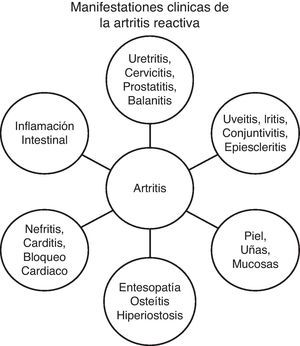 Manifestaciones clínicas de la artritis reactiva.