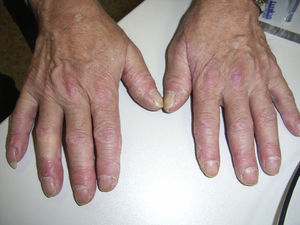 Manos de mecánico: lesiones hiperqueratósicas y fisuras en cara lateral y palmar de los dedos.