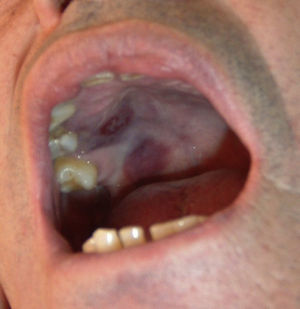 Placas de sarcoma de Kaposi en el paladar blando.