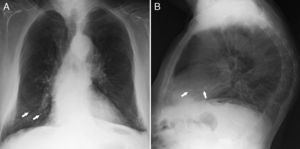 Radiografía de tórax posteroanterior (A) y lateral (B) en la que se observan imágenes radiopacas sobre el trayecto de los vasos pulmonares (flechas) en el tercio inferior del hemitórax derecho, en relación con émbolos de cemento a dicho nivel.