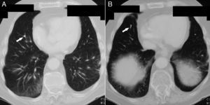 Tomografía computarizada de tórax mostrando émbolos de cemento (flechas) en bifurcaciones (A) y ramas distales (B) de la arteria pulmonar derecha a nivel del lóbulo inferior.
