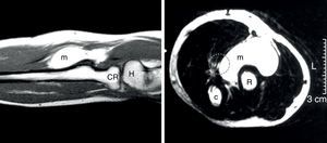Resonancia magnética de antebrazo en T2. Izquierda: aspecto longitudinal donde se observa la masa anterior al radio. Derecha: corte transversal que demuestra la masa provocando un desplazamiento del área teórica por donde discurre el nervio mediano (circulo punteado). c: cúbito; CR: cabeza del radio; H: húmero; m: masa; R: radio.