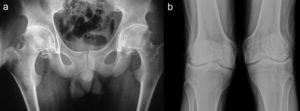 a y b) Radiografías de coxofemorales y rodillas con datos degenerativos severos.