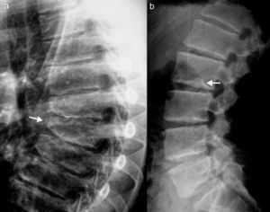 a y b) Cuerpos vertebrales torácicos y lumbares aplanados, con irregularidades en mesetas vertebrales (platispondilia).