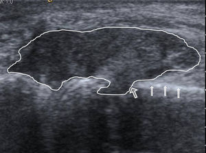 Corte longitudinal a la altura de la cabeza del quinto metacarpiano derecho. Se objetiva una masa de partes blandas en contacto con la cortical ósea (flechas estrechas) y erosión de la cortical (flecha gruesa) con la masa de partes blandas en la medular del metacarpiano.
