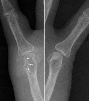 Radiografías centradas en la quinta articulación metacarpofalángica de ambas manos que permite valorar comparativamente la erosión ósea de margen escleroso (flechas) con el aumento de las partes blandas, de alta densidad, en la vertiente medial de la cabeza del metacarpiano derecho. No hay afectación del espacio articular.