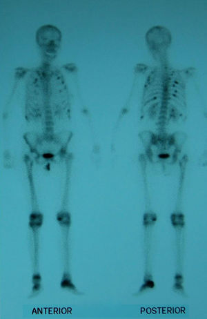 Gammagrafía con hipercaptación múltiple en las costillas, cadera izquierda fracturada, calcáneo izquierdo y articulaciones periféricas.