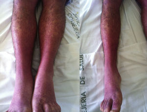 Exantema y edema en extremidades.