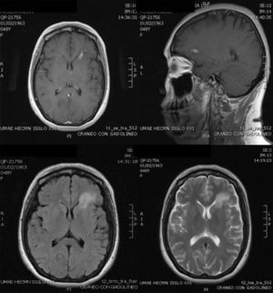 RMN al momento del ingreso: los espacios de LCR, el cerebelo, bulbo, puente, mesencéfalo, cuerpo calloso y hemisferio derecho son normales. En el hemisferio izquierdo a nivel de la sustancia blanca profunda del lóbulo frontal se demuestra un área de hipo-hiperintensidad de señal en T1 y T2, respectivamente, de aspecto «edematoso», bilobulada que mide aproximadamente 17×6mm, circundada por edema vasogénico y que impregna intensa y anularmente tras la aplicación de contraste por vía intravenosa. Cambios compatibles con neuroinfección. Absceso bilobulado frontal izquierdo.