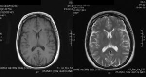 RMN cerebral contrastada con gadolinio a los 4 meses de inicio del tratamiento con resolución de la lesión, sin evidencia de neuroinfección.