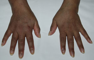 Hiperpigmentación en dorso de las manos y melanoniquia lineal.