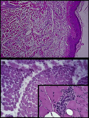 A) Biopsia de piel: espongiosis ligera y algunas mitosis en dermis en espacios claros por edema e infiltrado moderado difuso por linfocitos, células plasmáticas y escasos eosinófilos, distribuidos en dermis papilar y en la periferia de los anexos. B) Biopsia de músculo: infiltrados inflamatorios de predominio de tejido conjuntivo perimisial y de los vasos de pequeño calibre, que presentan lesión de endotelio y fibrosis (acercamiento).