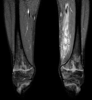 The MRI study revealed the suspected pyomyositis.