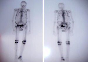 Gammagrafía con múltiples focos de hipercaptación que interesa a ambas parrillas costales, sacroilíaca derecha, cuerpo del pubis, ambas rodillas y tobillo derecho.