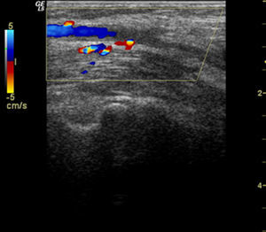 Imagen de trombosis arteria humeral.