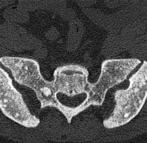 TAC de pelvis: pequeñas áreas hiperdensas en el sacro y en ambos huesos iliacos, por lo general<10mm y sin signos de malignidad.