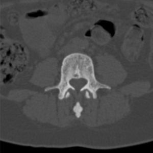 TAC columna lumbar: pequeñas áreas de densidad aumentad en cuerpos vertebrales.