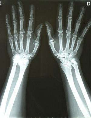 Radiografía posteroanterior de ambos carpos.