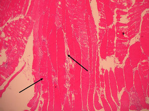 Biopsia de músculo 100X. Aumento de volumen, cambio de coloración y destrucción de fibras musculares rodeadas de infiltrado inflamatorio.