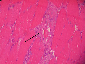 Biopsia de músculo 400X. Escaso infiltrado inflamatorio de macrófagos entre las fibras musculares con signos de atrofia y destrucción.