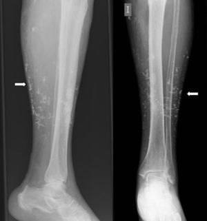 Radiografía simple de la extremidad inferior izquierda, que muestra calcificaciones en tejido celular subcutáneo.