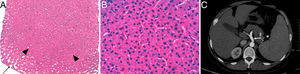 Biopsia hepática en la que se observa una zona nodular hiperplásica (cabezas de flecha) rodeada parcialmente por sinusoides dilatados (flecha) y ausencia de fibrosis (hematoxilina-eosina 2×) (A). A mayor aumento, los sinusoides se encuentran comprimidos por las placas hepatocitarias engrosadas (hematoxilina-eosina 40×) (B). En la tomografía computarizada abdominal, se evidencia la dilatación de la vena porta y sus ramas (flecha) (C).
