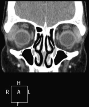 Resonancia magnética cerebral: aumento de tamaño de la región orbitolatetal superior de ojo derecho, compatible con proceso infiltrativo.