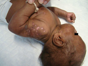 Caso clínico 2. Lesiones residuales cicatriciales de lupus cutáneo subagudo.