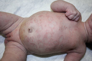 Caso clínico 4. Lesiones cutáneas en forma de placas de aspecto anular, eritematosas, con centro de aspecto más claro, confluentes principalmente a nivel facial.