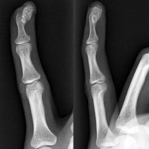 Radiografías anteroposterior (A) y lateral (B) del quinto dedo de mano izquierda en las que se observa una lesión nodular osificada adherida al periostio de la falange distal, sin erosión de la cortical.
