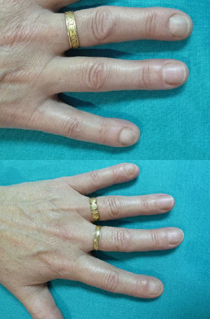 Uñas de las manos sin alteraciones 6 meses después.