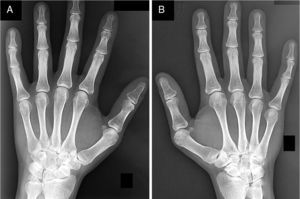 Radiografías anteroposterior de carpos izquierdo (A) y derecho (B) mostrando deformidad de Madelung bilateral.