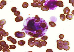 Aspirado de médula ósea que muestra histiocito con actividad hemofagocítica (tinción de Wright-Giemsa).