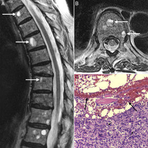 Resonancia magnética de columna dorsolumbar mostrando, en los cortes sagital (A) y axial (B) de la secuencia potenciada en T2, la presencia de múltiples lesiones vertebrales con niveles líquido-líquido típicos, con hiperseñal en el nivel superior e hiposeñal en el inferior. La biopsia ósea (C) reveló que dichas lesiones correspondían a metástasis de un adenocarcinoma pobremente diferenciado con células en anillo de sello (cabezas de flechas), rodeando un contenido hemorrágico (flechas) (hematoxilina-eosina 10×).