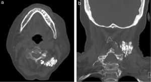 TC cervical, corte horizontal y frontal.