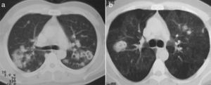 La tomografía axial computarizada de nódulos pulmonares muestra: a)nódulo no cavitado, nódulos cavitados y consolidación, y b)patrón en mosaico, nódulos cavitados y micronódulos centrilobulillares en la periferia de segmento anterior del lóbulo superior izquierdo.