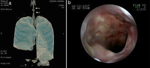 La tomografía axial computarizada pulmonar muestra: a)vidrio esmerilado generalizado, nódulos cavitados y consolidación cavitada, y b)neumonía cavitada en el segmento superior de lóbulo inferior derecho y nódulos no cavitados en el lóbulo inferior izquierdo.