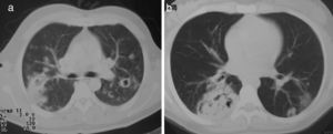 a)Estenosis traqueal. b)Imagen por broncoscopia de traqueítis ulcerada; en histología se mostró vasculitis necrosante granulomatosa.