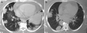 a y b)Nódulos y masas en lóbulo inferior derecho y consolidación en periferia de lóbulo inferior izquierdo; el análisis histopatológico mostró combinación de vasculitis necrosante granulomatosa y neumonía organizada.